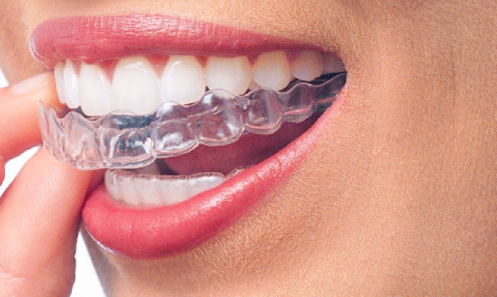 Straighten Your Teeth With Invisalign Treatment